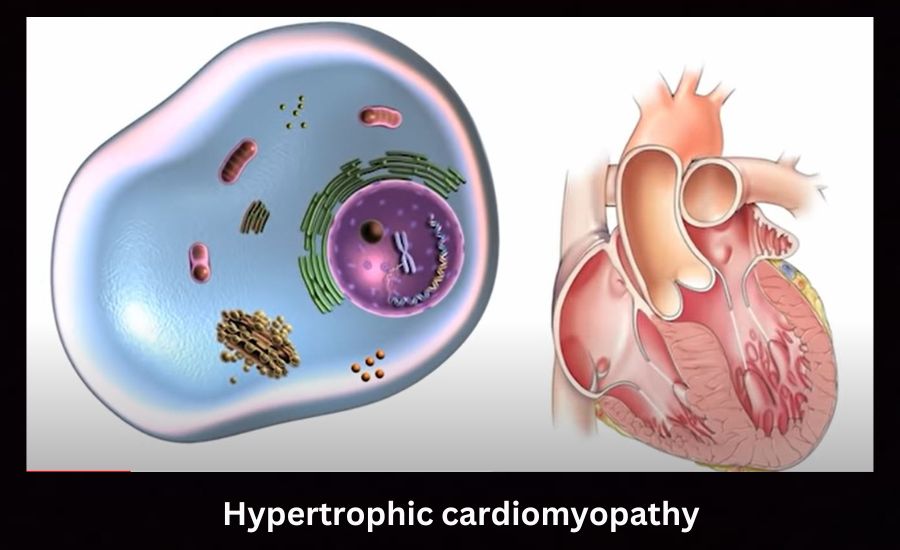 Hypertrophic cardiomyopathy